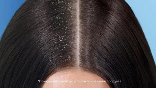 Обложка курса: Избавляемся от перхоти за 1 раз. Площадка: Складчина.biz