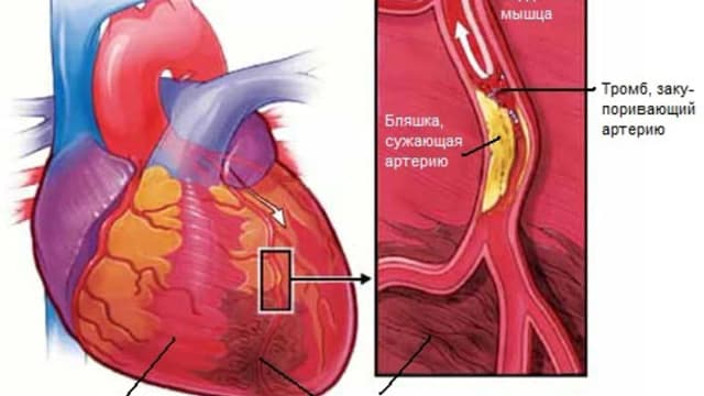 Обложка курса: Скорая Помощь после Инфаркта. Площадка: Складчик